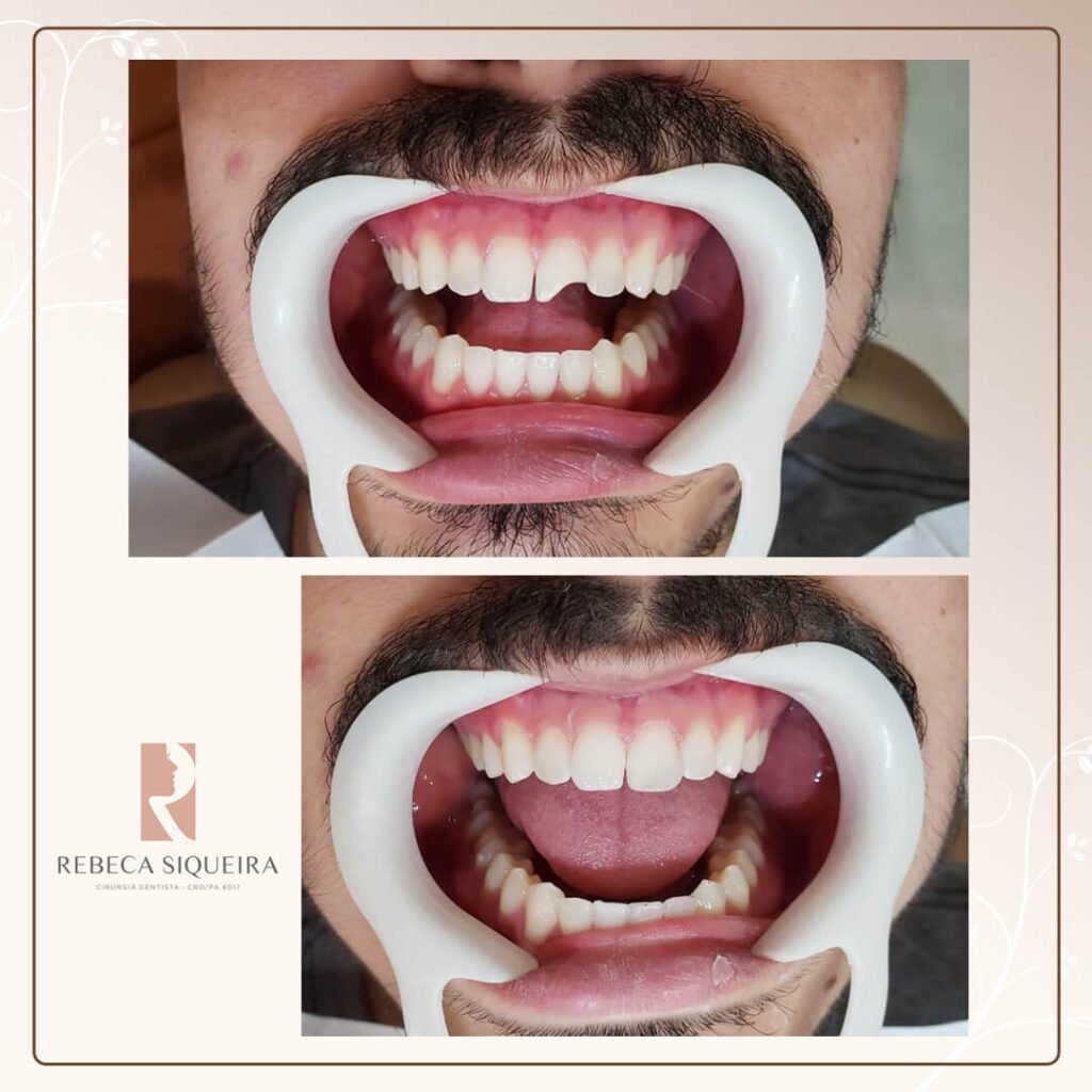 implante dentário Castanhal