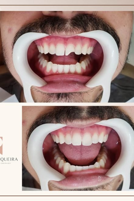 implante dentário Castanhal